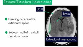 Extradural vs Subdural Haematomas – How do we Diagnose them on CT.