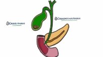 Gallstone Disease – Acute Cholecystitis vs Cholelithiasis vs Choledocholithiasis vs Cholangitis