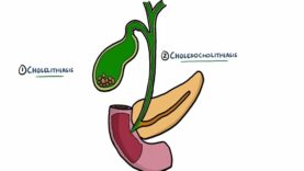 Gallstone Disease – Acute Cholecystitis vs Cholelithiasis vs Choledocholithiasis vs Cholangitis