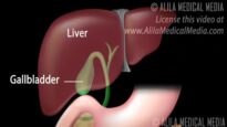 Gallstones and Surgical Removal of Gallbladder (Cholecystectomy) Animation