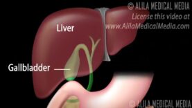 Gallstones and Surgical Removal of Gallbladder (Cholecystectomy) Animation
