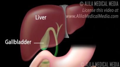 Gallstones and Surgical Removal of Gallbladder (Cholecystectomy) Animation