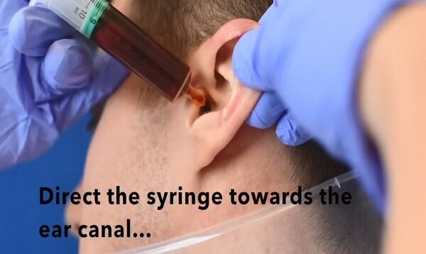 How to Perform an Ear Washout – ENT-Otolaryngology Skills