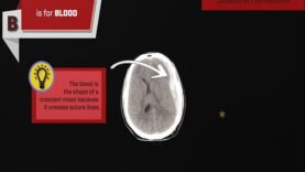 How to Read a CT Scan of the Head