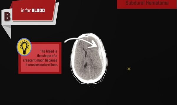 How to Read a CT Scan of the Head