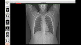 How I Read a Chest CT