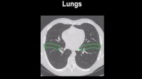 How to identify normal lung anatomy on chest CT1