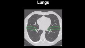How to identify normal lung anatomy on chest CT1