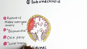 Intracranial Hemorrhage- Epidural-Subdural-Subarachnoid overview