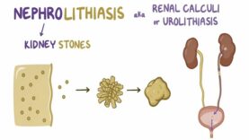 Kidney stones (nephrolithiasis)