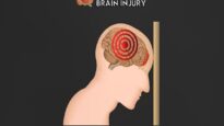 Overview of Traumatic Brain Injury