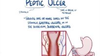 Peptic ulcer disease – causes, symptoms, diagnosis, treatment, pathology