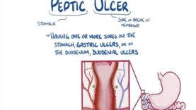 Peptic ulcer disease – causes, symptoms, diagnosis, treatment, pathology