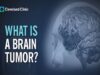 Primary Brain Tumors – What Are They and How Do They Form.