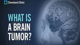 Primary Brain Tumors – What Are They and How Do They Form.