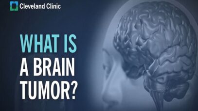 Primary Brain Tumors – What Are They and How Do They Form.