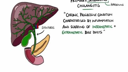 Primary Sclerosing Cholangitis v Primary Biliary Cholangitis (Primary Biliary Cirrhosis)