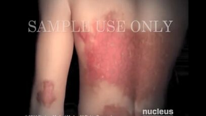 Psoriasis
