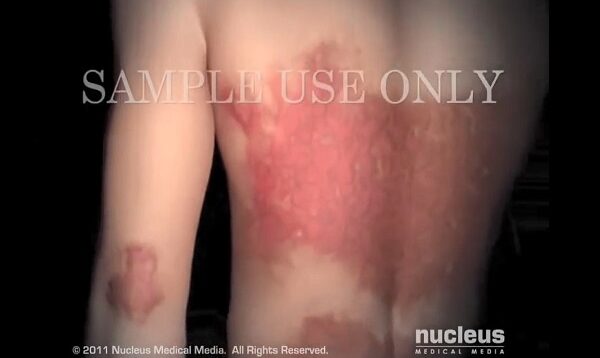 Psoriasis
