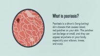 Psoriasis- Signs, Symptoms, Causes, and Treatment