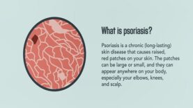 Psoriasis- Signs, Symptoms, Causes, and Treatment