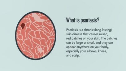 Psoriasis- Signs, Symptoms, Causes, and Treatment