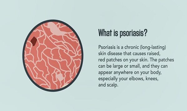 Psoriasis- Signs, Symptoms, Causes, and Treatment