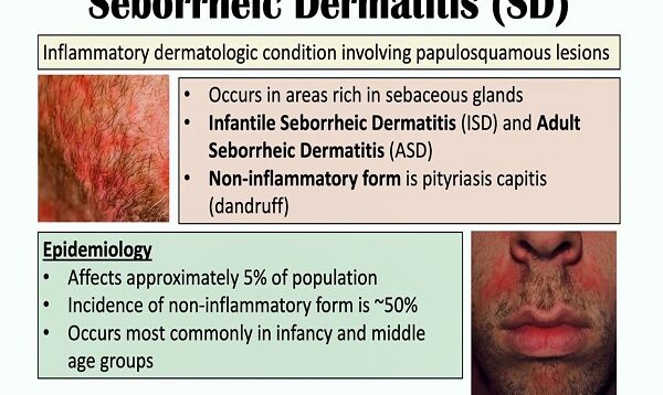 Seborrheic Dermatitis (Dandruff and Cradle Cap) Causes, Risk Factors, Symptoms, Diagnosis, Treatment
