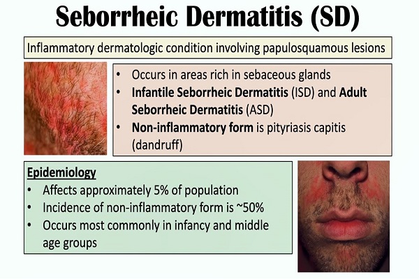 Seborrheic Dermatitis (Dandruff and Cradle Cap) Causes, Risk Factors, Symptoms, Diagnosis, Treatment