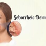 Seborrhoeic Dermatitis- Everything You Need To Know