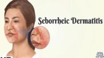 Seborrhoeic Dermatitis- Everything You Need To Know