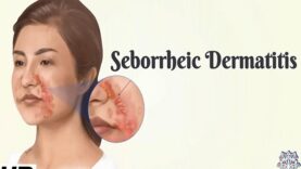 Seborrhoeic Dermatitis- Everything You Need To Know