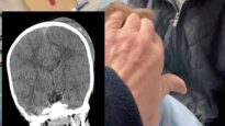 Skull Fracture Emergency in a 4-Year-Old Boy