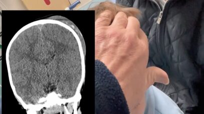 Skull Fracture Emergency in a 4-Year-Old Boy