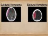 Subdural vs Epidural Hematoma-Hemorrhage [CT Scan Findings]
