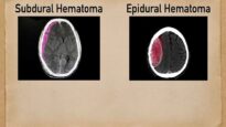 Subdural vs Epidural Hematoma-Hemorrhage [CT Scan Findings]