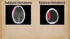 Subdural vs Epidural Hematoma-Hemorrhage [CT Scan Findings]