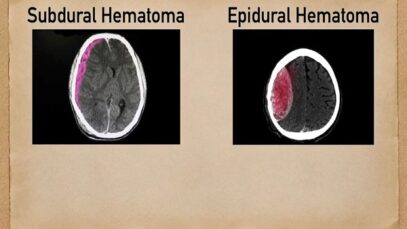 Subdural vs Epidural Hematoma-Hemorrhage [CT Scan Findings]