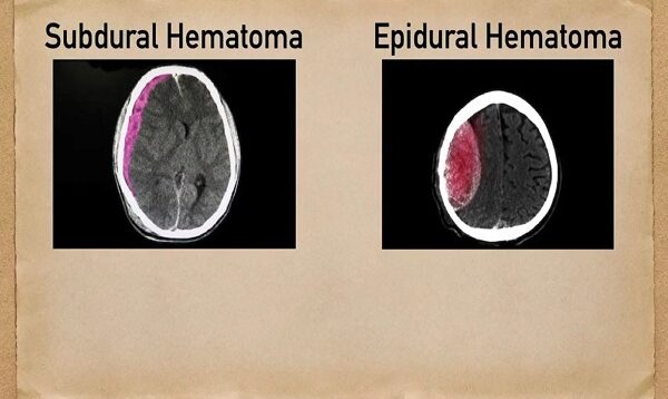 Subdural vs Epidural Hematoma-Hemorrhage [CT Scan Findings]