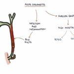 Understanding Acute Cholangitis (Ascending Cholangitis)