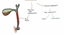 Understanding Acute Cholangitis (Ascending Cholangitis)