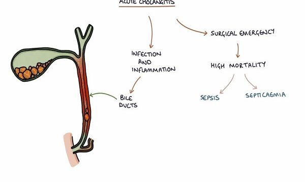 Understanding Acute Cholangitis (Ascending Cholangitis)