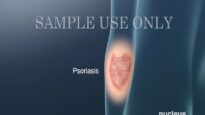 Understanding Psoriasis