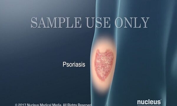Understanding Psoriasis