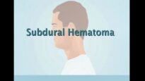 Understanding Subdural Hematoma