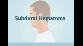 Understanding Subdural Hematoma