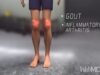 What Happens During a Gout Attack