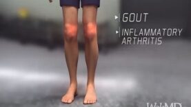 What Happens During a Gout Attack