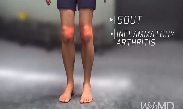 What Happens During a Gout Attack
