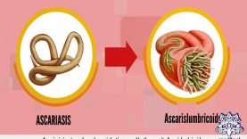 Ascariasis, Causes, Signs and Symptoms, Diagnosis and Treatment.